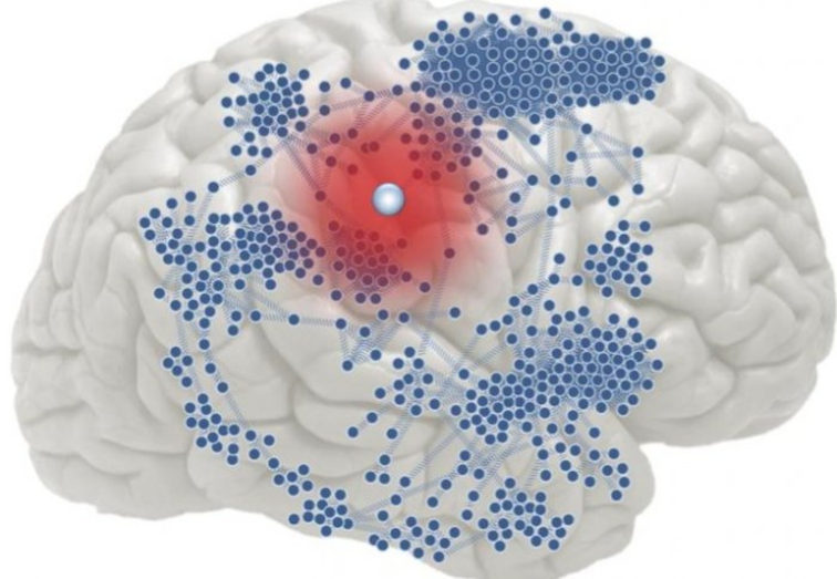 BRAIN SCIENCES_epilepsy2