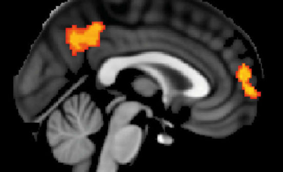 DeviceInnovation Non-invasive brain stimulation could provide a new treatment for dementia