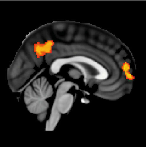 Lucia-Li-et-al-Abnormal_brain_activation