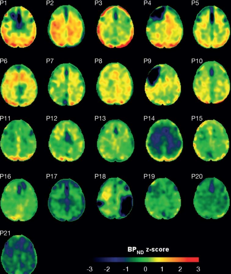 Tau Protein after brain injury