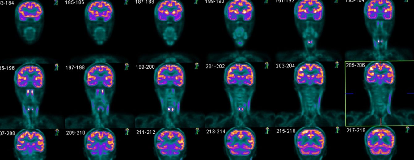 brain-pet-scan-2x