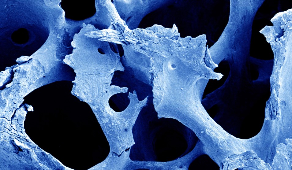 osteoporosis