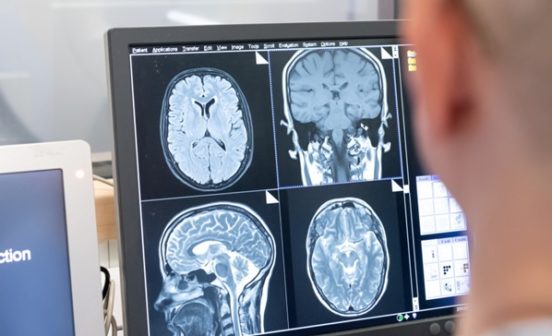 PreventionTreatment Study links COVID-19 to biomarkers for abnormal brain proteins
