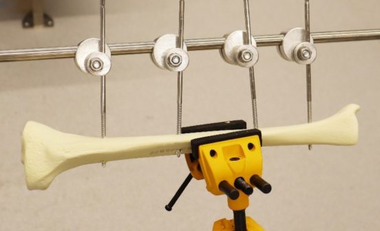 Device Imperial Designed External Fixator Aims to Cater to the High-conflict Regions of the Low and Middle-Income Countries