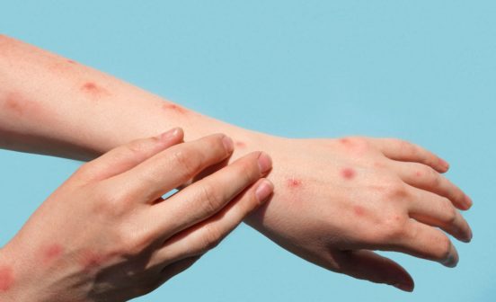 Showing two hands with Mpox symptoms